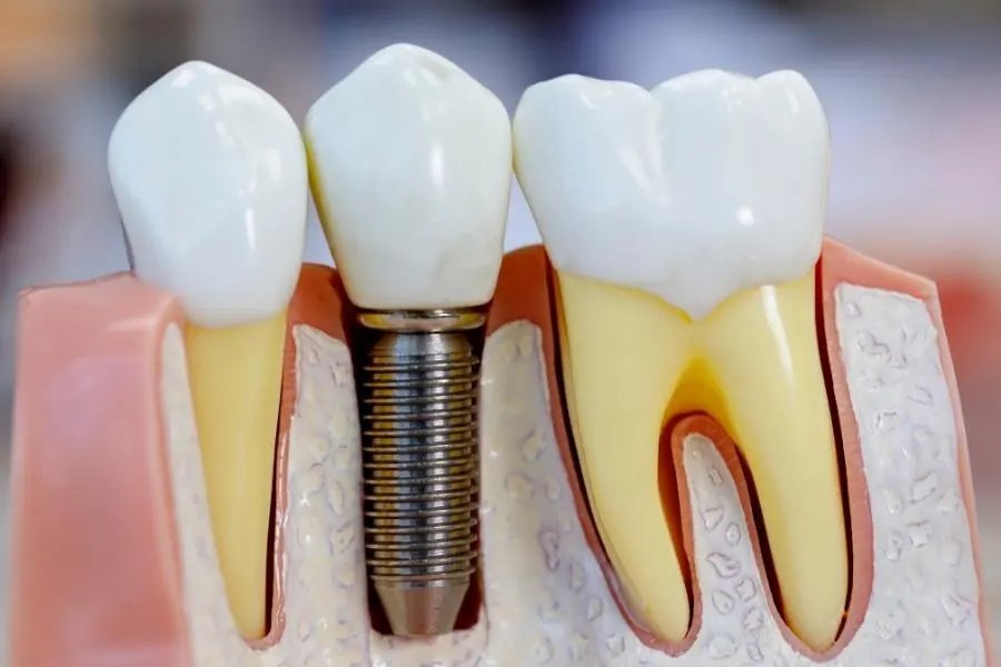 beneficios de los implantes dentales