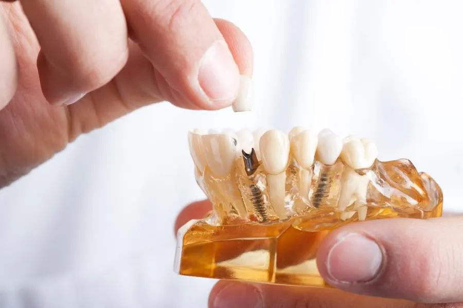 Cuánto cuesta un implante dental en Perú