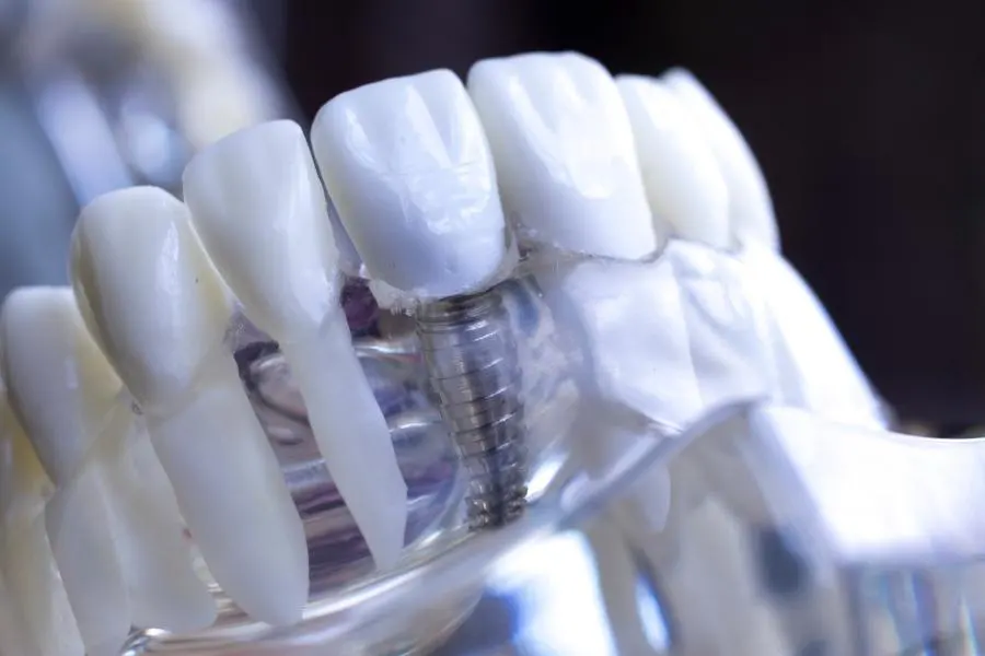 Costo de implantes dentales