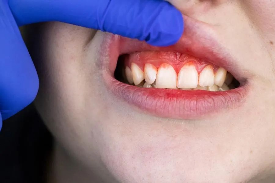 tratamiento de las encias