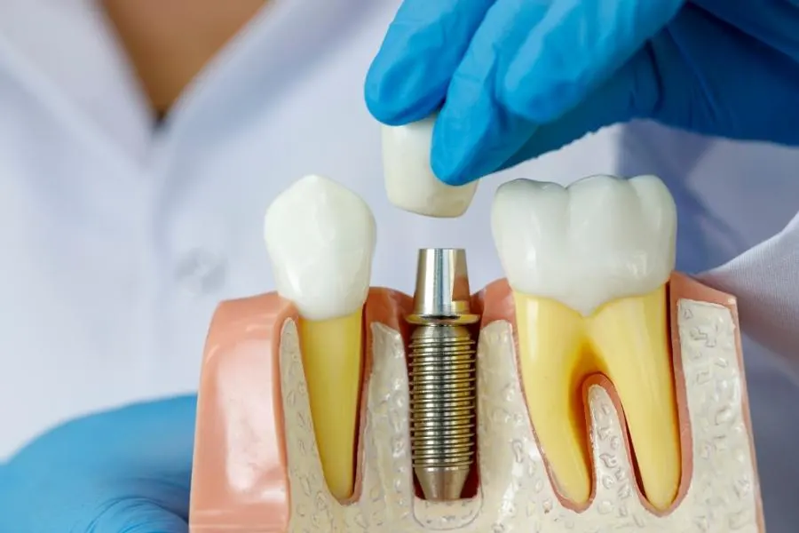 implantes dentales en Perú
