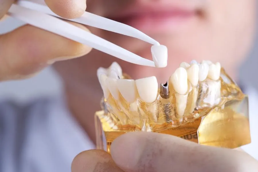 10 razones por las cuáles deberías elegir a los implantes dentales