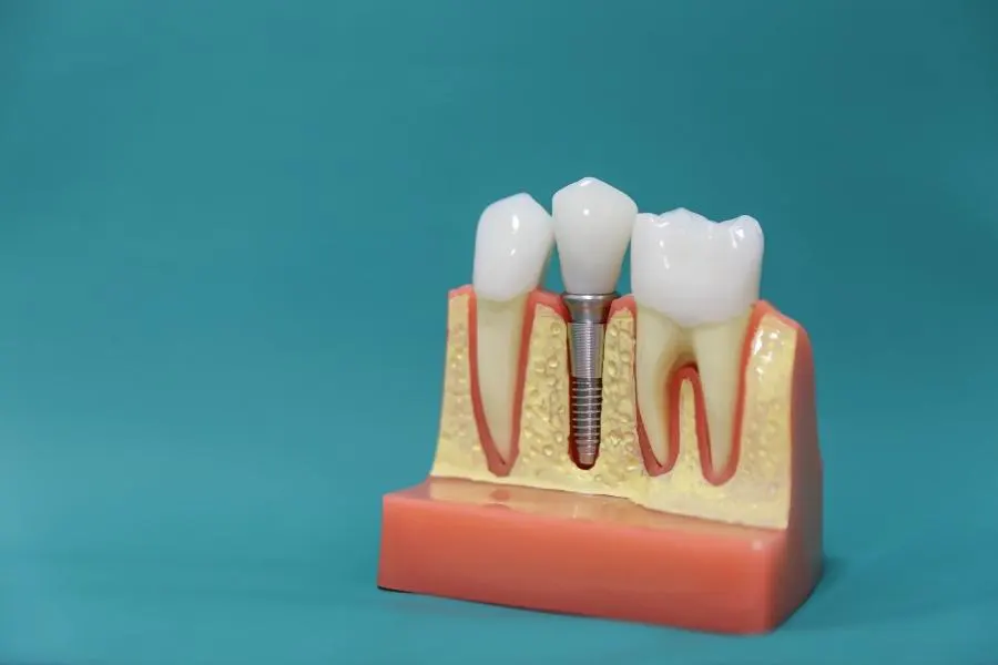 riesgos en implantes dentales