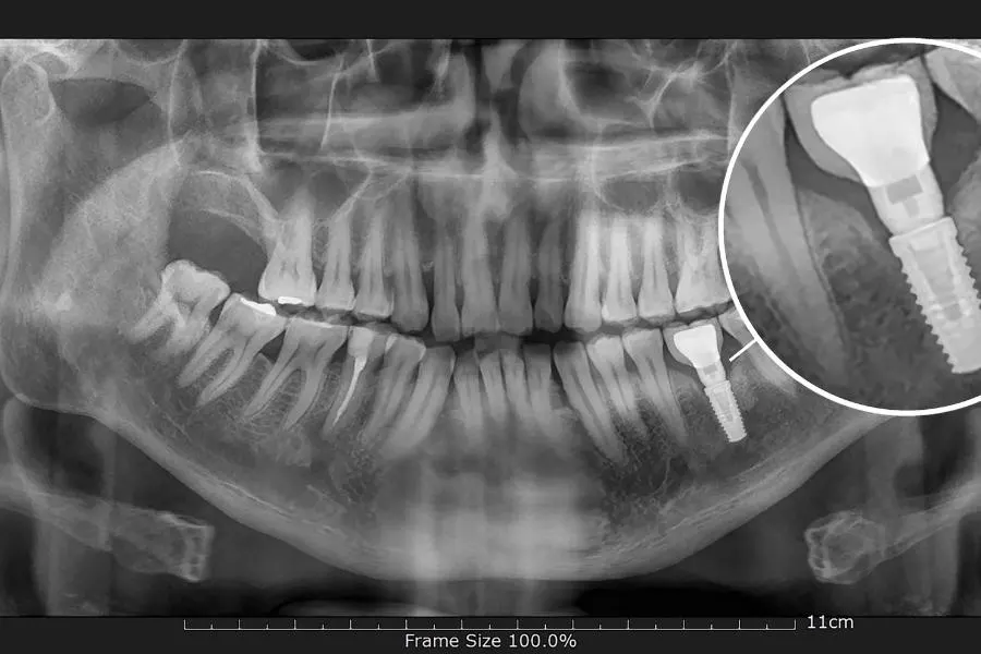 identifica una intrusión dental
